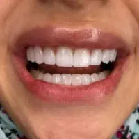 دندانپزشکی خیریه « ایمپلنت عصب کشی کامپوزیت لمینت|خدمات زیبایی و سلامت|قم, مصلاء|دیوار