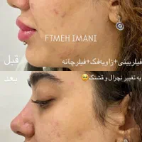 تزریقات ژل‌ لب زاویه فک و بوتاکس با بهترین متریال|خدمات آرایشگری و زیبایی|مشهد, توس (بلوار توس)|دیوار