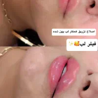 ژل وبوتاکس|خدمات آرایشگری و زیبایی|اهواز, کمپلو شمالی|دیوار