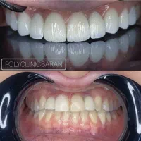 کشیدن دندان/عصب کشی و ترمیم/زیبایی