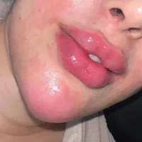 ژل لب.بوتاکس