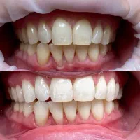 بلیچینگ تخصصی توسط دندانپزشک