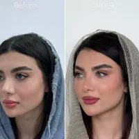 فیلر صورت و بینی کانتورینگ پی آر پی  ژل لب بوتاک