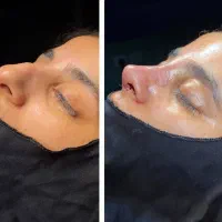 عمل بینی/ عمل زیبایی بینی/ بلفارو