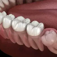 کشیدن و جراحی دندان عقل