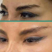 لیفت گونه خط خنده شقیقه بلفارو دایرکت ابرو