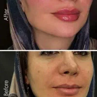جشنواره کانتورینگ فول فیس با تزریق فیلر توسط پزشک|خدمات آرایشگری و زیبایی|نسیم‌شهر, |دیوار