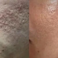 پاکسازی فیشال بوتاکس مزوتراپی آموزش