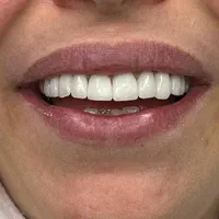 دندانپزشکی، کامپوزیت و لمینیت ، بلیچینگ
