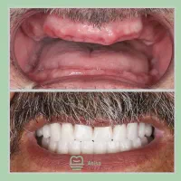 مرکز تخصصی کاشت دندان ایمپلنت یکروزه بدون درد