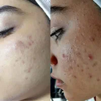 انجام خدمات درمانی پوست توسط مدرس با ۸سال سابقه.