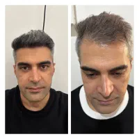 کاشتموتخصصی دراردبیل باشرایط ویژه