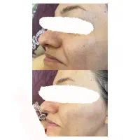 پاکسازی و فیشال پوست|خدمات آرایشگری و زیبایی|مشهد, امام رضا (ع)|دیوار