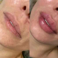 ژل و بوتاکس|خدمات آرایشگری و زیبایی|مشهد, طلاب|دیوار