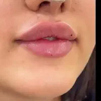 تزریق ژل و بوتاکس