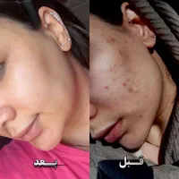 کرم بیوممتیک بوتاکس