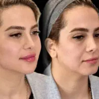 فیلر ژل لب بوتاکس تخصصی پزشک کلینیک تهرانسر|خدمات آرایشگری و زیبایی|اسلام‌شهر, باغ فیض|دیوار