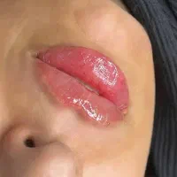 تخفیف ویژه تزریق فیلر