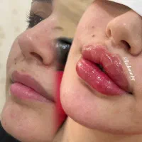 ژل بوتاکس آموزش