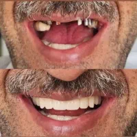 کامپوزیت دندانپزشکی تخفیفه ویژه اقساط چکی|خدمات آرایشگری و زیبایی|تهران, شهرک ولیعصر جنوبی|دیوار