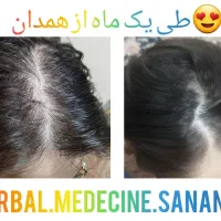 رشد مجدد رفع ریزش و مشکلات خودایمنی و پوستی