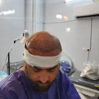 کاشت مو/پیوند مو/کاشت ابرو/کاشت ریش|خدمات آرایشگری و زیبایی|شیراز, وحدت|دیوار