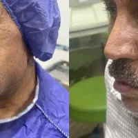 بلفارو/ لیفت صورت و ابرو/غبغب/تزریق چربی با تخفیف|خدمات آرایشگری و زیبایی|مشهد, سجاد شهر|دیوار