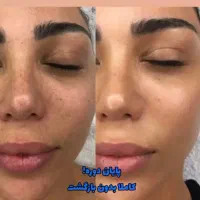 زیبایی پوستت رو به ما بسپر|آرایشی، بهداشتی، درمانی|تهران, سلسبیل شمالی|دیوار