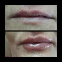 تخفیف ویژه فیلر فقط۵۹۹بوتاکس فقط۶۹۹|خدمات آرایشگری و زیبایی|محمدیه-قزوین, |دیوار
