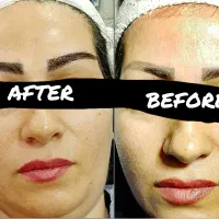 کاشت مو و ابروی طبیعی|خدمات آرایشگری و زیبایی|تهران, زعفرانیه|دیوار