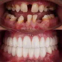 تخفیف ویژه ایمپلنت دیجیتال در مرکز تخصصی