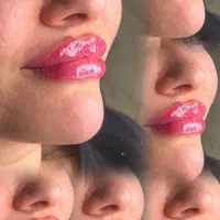 آموزش فیلر و بوتاکس توسط مدرس بین المللی