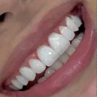 کامپوزیت دندانپزشکی روکش تهرانسر سعادت آباد صادقیه