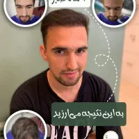 کاشت تخصصی مو و ابروی تاج، شرایط اقساط ویژه