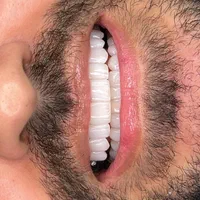 کامپوزیت دندان دندانپزشکی لمینت روکش ایمپلنت|خدمات آرایشگری و زیبایی|تهران, فردوس|دیوار