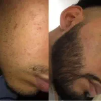 بدون دردسر ریشا.تو ۳۰روزه.پرکن