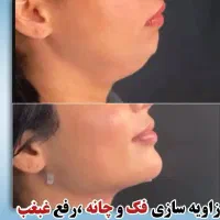 جشنواره ۵۰ درصدی ژل بوتاکس فقط تا سه روز|خدمات آرایشگری و زیبایی|اصفهان, برازنده|دیوار