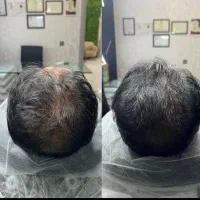 میکرواسکالپ /اسکالپ پرپشتی تضمینی مو در کلینیک