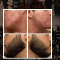 این سرم معجزه ریشاته
