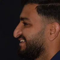 جراحی بینی فقط با 68 میلیون توسط جراح متخصص