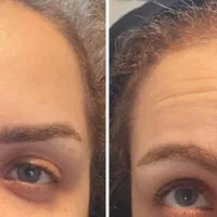 جشنواره بوتاکس اصل مصپورت کل صورت فقط 950