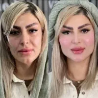 کلینیک جراحی نخ آنزیم غبغب مزو ژل فیلر بوتاکس|خدمات آرایشگری و زیبایی|کرج, گوهردشت|دیوار