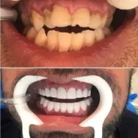 دندانپزشکی/لمینت/روکش|خدمات آرایشگری و زیبایی|تهران, فلسطین (میدان انقلاب)|دیوار