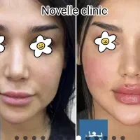 فراخوان مدل زیبایی برای تزریق فیلر و بوتاکس