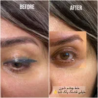 ریموو و پاک کردن تتوهای قدیمی|خدمات آرایشگری و زیبایی|تبریز, |دیوار
