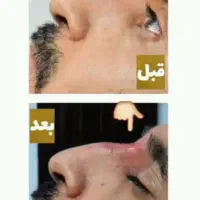 ژل بوتاکس آنزیم خال برداری فیلربینی فول فیس بلفارو