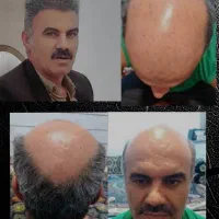 کاشت مو.ابرو.ریش.فول تراکم با شرایط استثنایی|خدمات آرایشگری و زیبایی|شیراز, ستارخان|دیوار