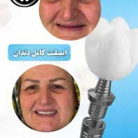 کاشت اقساطی ایمپلنت دندان (با ۱۰ تومن شروع کن)