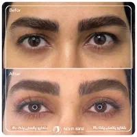 بلفاروپلاستی ورفع افتادگی پلک وبوتاکس حرفه ای