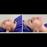 آف ویژه ساکشن غبغب ،بوکال فت،بلفارو پلک و عمل بینی